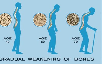 Osteoporosis – What is it and some preventative measures